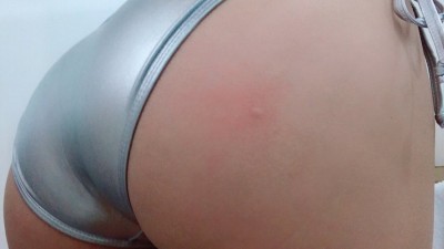 모기물린엉덩이